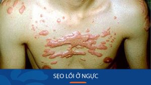 Sẹo lồi ở ngực: Nguyên nhân, triệu chứng và cách điều trị hiệu quả