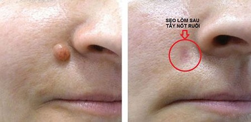 sẹo lõm tẩy nốt ruồi