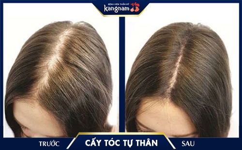 cấy tóc tự thân kangnam