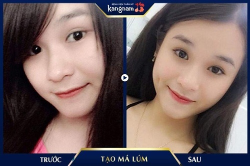 làm má lúm kiêng bao lâu thì đẹp? làm má lúm kiêng bao lâu