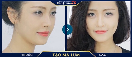 tạo má lúm đồng tiền 