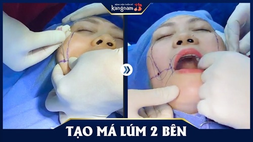 tạo má lúm kangnam 