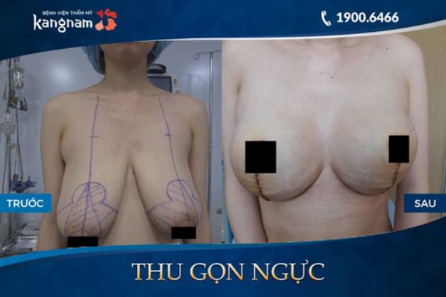 Vòng 1 cân đối và tự nhiên như thật