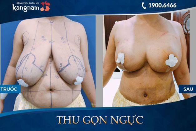 Combo thu gọn ngực và treo sa trễ