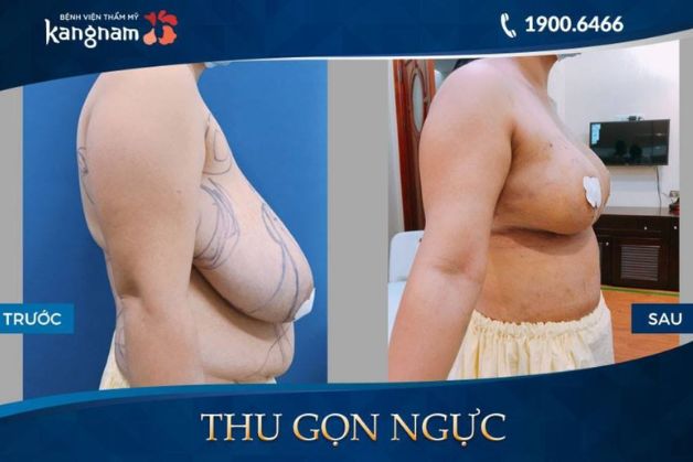 Vòng 1 săn chắc, cân đối và không chảy xệ