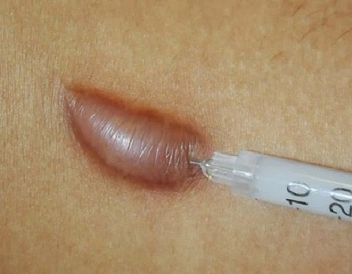 Tiêm sẹo lồi giúp làm xẹp và ức chế sự tăng trưởng các mô sợi Collagen quá phát Tiêm sẹo lồi giúp làm xẹp và ức chế sự tăng trưởng các mô sợi Collagen quá phát