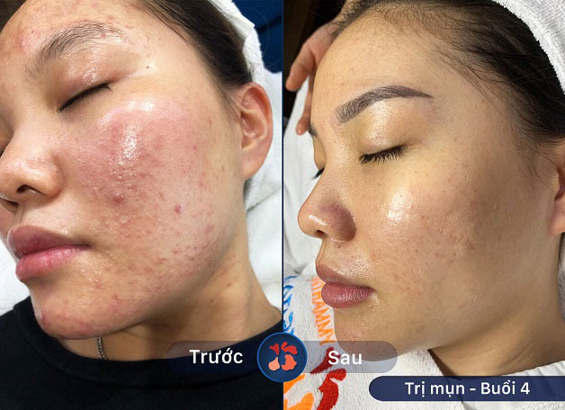 Mụn giảm nhanh sau 4 buổi thực hiện