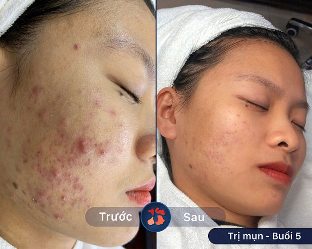 Tình trạng mụn bọc toàn mặt được loại bỏ hoàn toàn