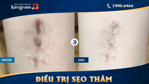 trị sẹo bỏng bô xe máy