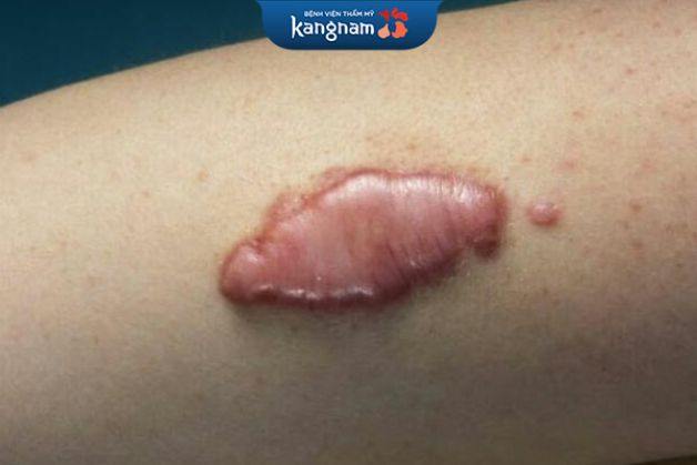 Sẹo lồi làm thế nào để hết?