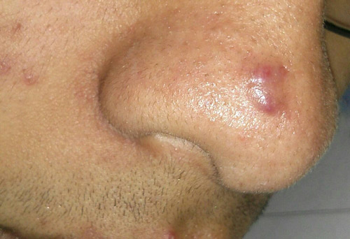 Sẹo lồi trên mũi thường có kích thước lớn hơn so với vết thương hở ban đầu trị sẹo lồi ở mũi