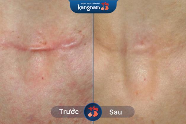 90% vết sẹo lồi kích thước lớn, thâm nặng lâu năm trên mặt khách hàng đã hoàn toàn biến mất