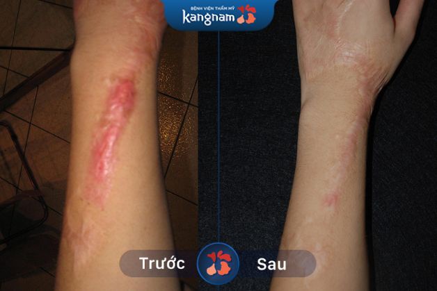 Sẹo lồi ở tay được xóa bỏ đáng kể, không còn nổi rõ gây mất thẩm mỹ