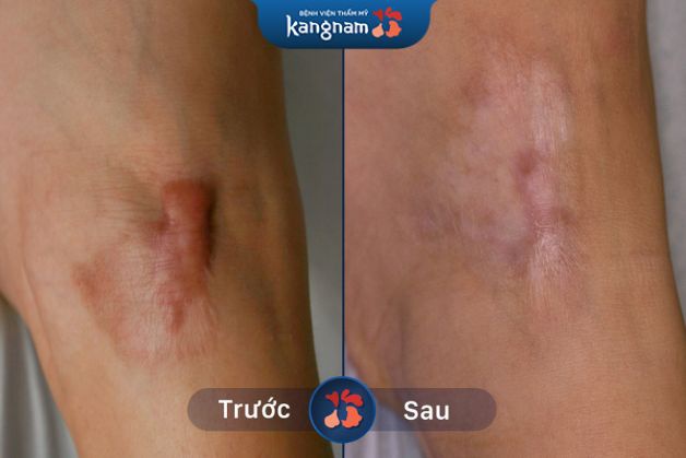 Sẹo lồi do tai nạn được là phằng hoàn toàn sau khi điều trị tại Bệnh viện thẩm mỹ Kangnam