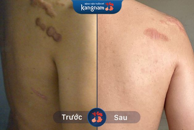 Làn da được cải thiện rõ rệt sau khi điều trị sẹo lồi biến dạng, xấu, co kéo nhiều