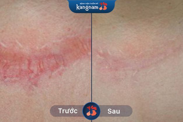 Sở hữu làn da sáng mịn, đều màu nhờ xóa sẹo thẩm mỹ bằng công nghệ cao