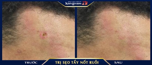 trị sẹo lõm sau khi tẩy nốt ruồi