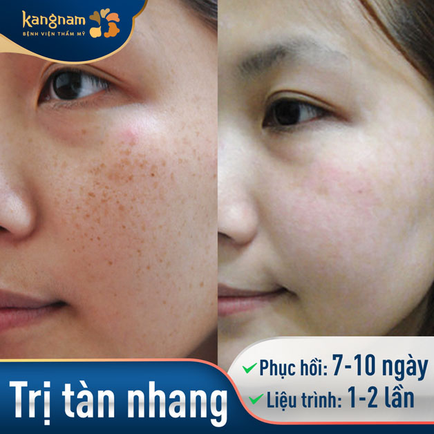 Làn da của khách hàng sau 1- 2 liệu trình trị tàn nhang