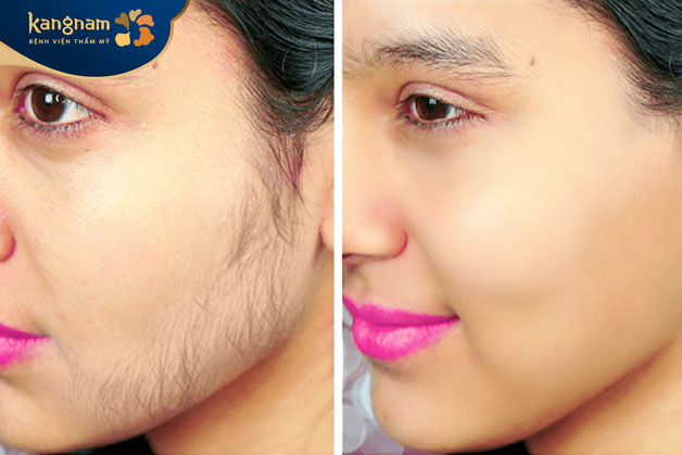 Lông mặt dài ảnh hưởng đến tự tin của khách hàng, khó khăn trong việc chăm sóc, cần cân nhắc loại bỏ