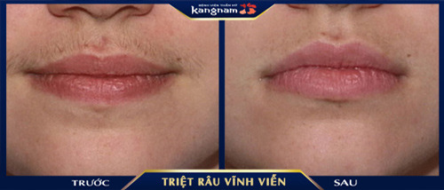 triệt râu