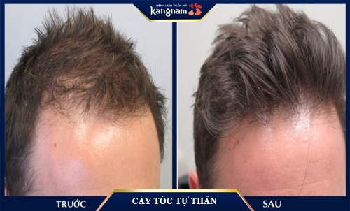 cấy tóc tại kangnam đau không? cấy tóc đau không