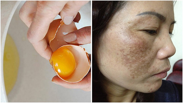 Trứng gà sở hữu lượng dưỡng chất thiết yếu giúp dưỡng da, mờ nám
