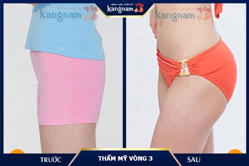 Mông bè, hóp 2 bên bẩm sinh đã được cải thiện toàn bộ giúp khách hàng sở hữu số đo 90 chuẩn tỷ lệ vàng 2 bên mông bị hóp