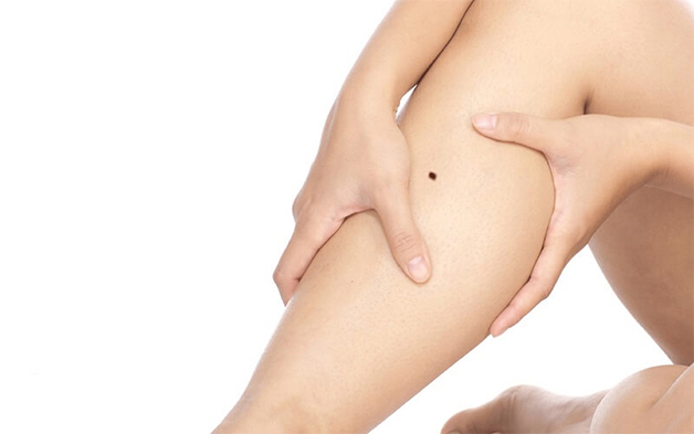 Nốt ruồi mọc ở bắp chân là nốt ruồi xấu tướng