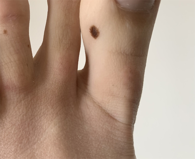 Ngón chân cái có nốt ruồi biểu hiện bạn là người luôn gặp may gặp mắn trong công việc và tình duyên