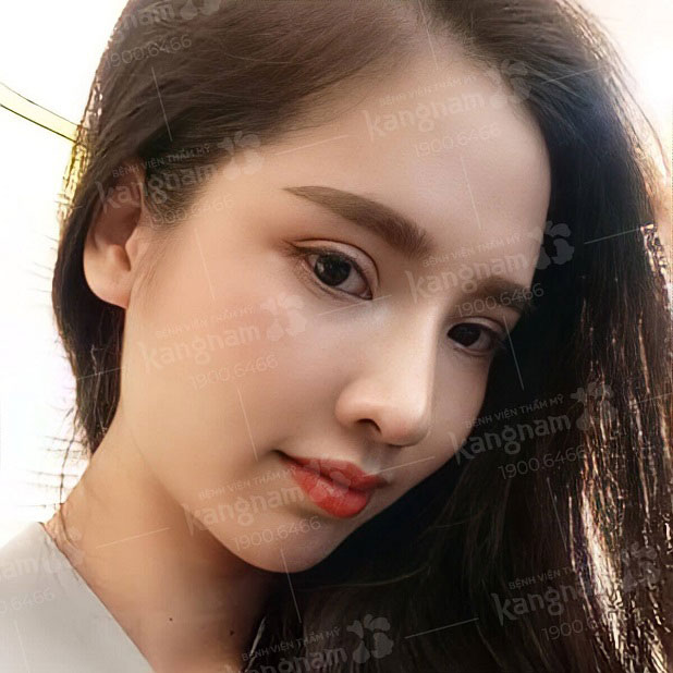 Chăm sóc theo hướng dẫn bác sĩ, cơ địa tốt có thể cười nhẹ nhàng sau 1 tuần