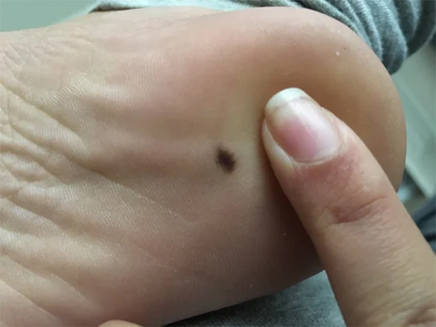 Nốt ruồi ở gót chân thể hiện bạn là người có tài lãnh đạo người khác 