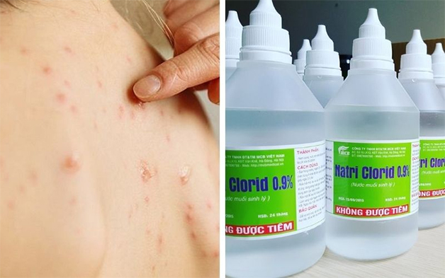 Sát khuẩn làn da lưng bị mụn sưng đỏ bằng dung dịch nước muối sinh lý