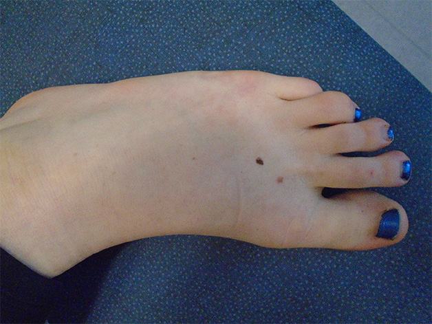 Nốt ruồi mu bàn chân biểu hiện tướng số cô đơn lúc hậu vận của gia chủ