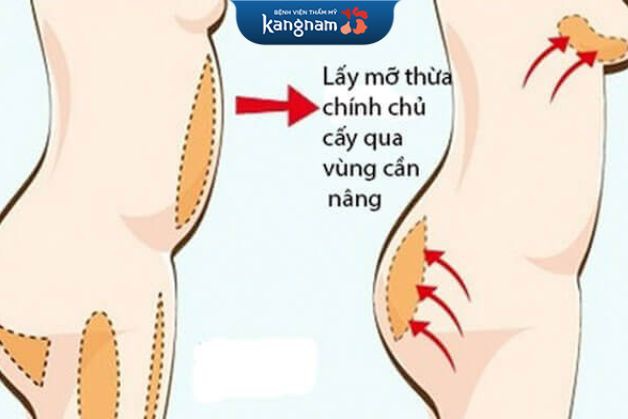 Phương pháp sử dụng chính mỡ tự thân của khách hàng để cấy vào vùng mông thiểu sản lép