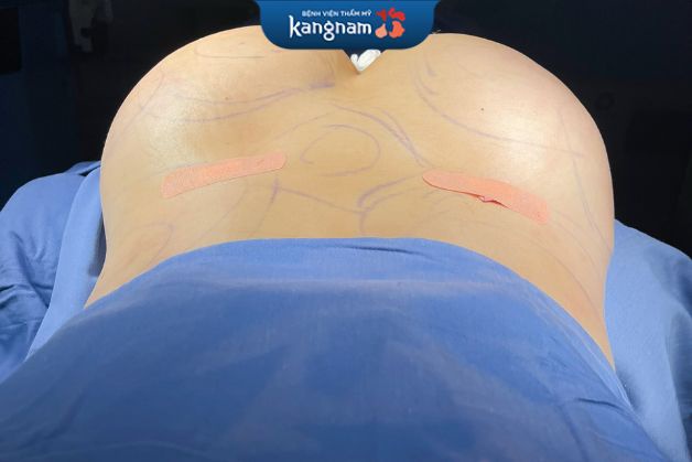 Nâng mông bằng công nghệ tại Kangnam đảm bảo tính hiệu quả