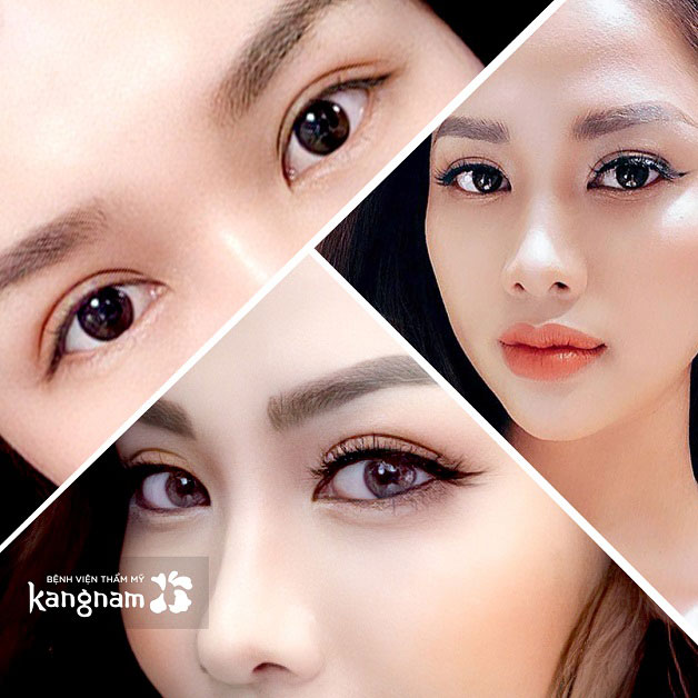 Khách hàng sau khi cắt mí