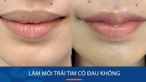 Làm môi trái tim có đau không? Nên lo lắng hay không?
