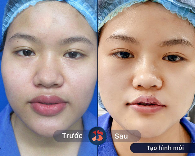 Trước và sau khi tạo hình môi