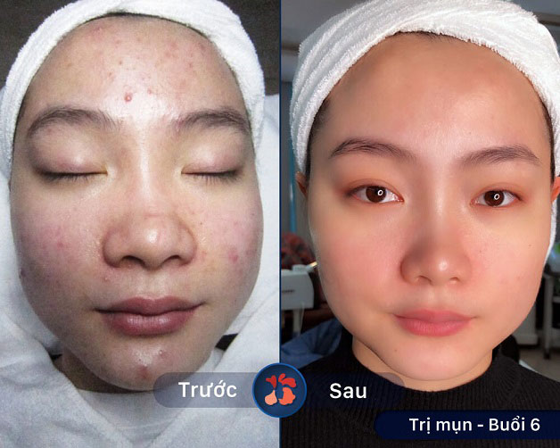 Hình ảnh trước - sau của khách hàng sau một liệu trình chuyên sâu trị mụn bọc