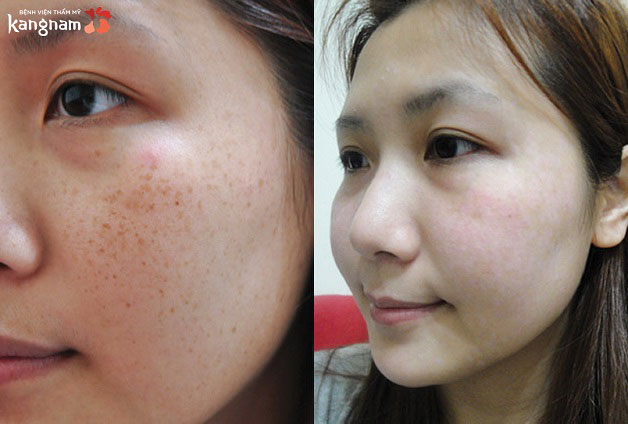 Kết quả sau khi khách hàng trị nám tại Kangnam, nám đã được loại bỏ hoàn toàn 