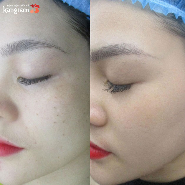 Gương mặt trở nên mịn màng và đẹp hơn sau khi tàn nhang đã được loại bỏ