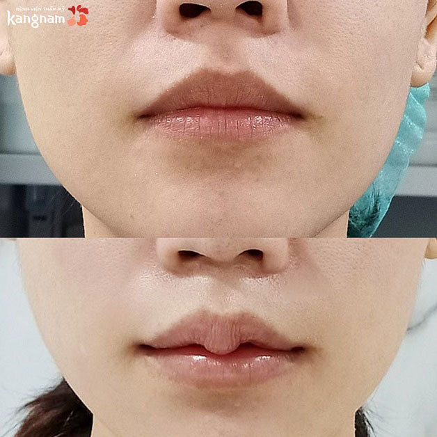 Khách hàng sau khi tạo hình môi tại Kangnam