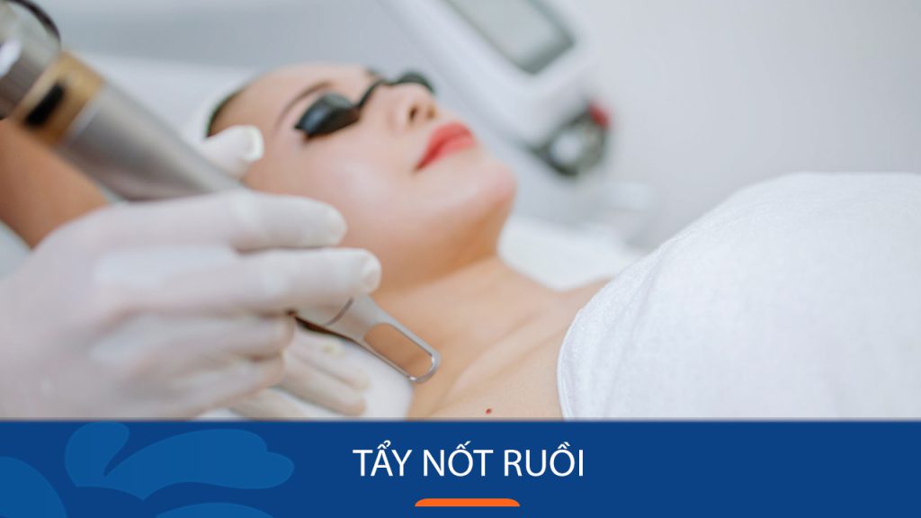 Tẩy Nốt Ruồi Nhanh Chóng – Giá Cực Tốt – Chỉ Có Tại Kangnam