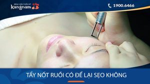Xóa nốt ruồi vĩnh viễn không sẹo: Giải đáp thắc mắc & Hướng dẫn chi tiết