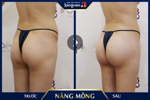 Kết quả nâng vòng 3 Kangnam ăn gì để vòng 3 nở nang
