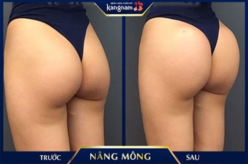 Kết quả khách hàng sau khi nâng vòng 3 tại Kangnam ăn gì cho mông nở