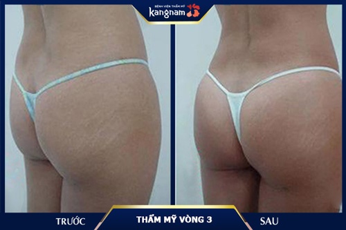 Cải thiện vòng 3 chảy xệ, không cân đối, lõm 2 bên cho khách hàng nữ sau sinh bài tập cho mông bị hóp 2 bên