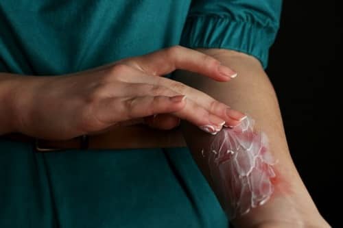 bôi thuốc điều trị vết bỏng