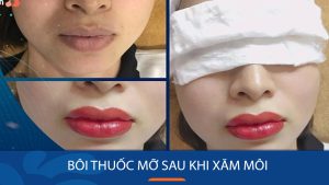 Có nên bôi thuốc mỡ sau khi xăm môi? Cách bôi đúng và hiệu quả nhất