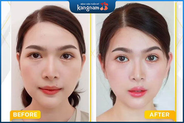 Gọt hàm không phẫu thuật